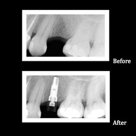 Granger Dentistry | Digital Radiography, Extractions and LANAP reg 
