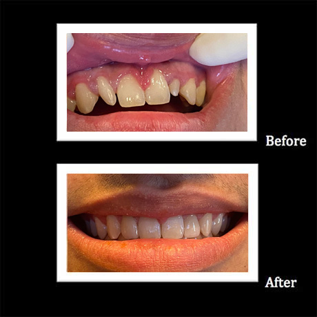 Healthy Teeth Family Dentistry | Dental Bridges, Crowns  amp  Caps and TMJ Disorders