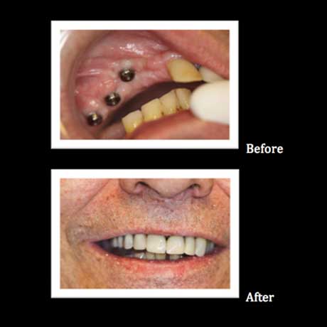 Healthy Teeth Family Dentistry | Implant Dentistry, All-on-4 reg  and Implant Supported Overdentures