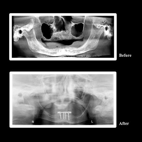 Healthy Teeth Family Dentistry | Dental Fillings, Dentures and Sleep Apnea